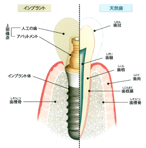 インプラントの構造