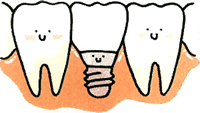 だからインプラントをお勧めします！