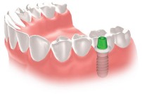 インプラント