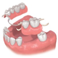 従来の治療方法　部分入れ歯