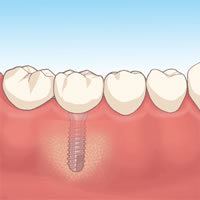 インプラントのメリット・デメリット