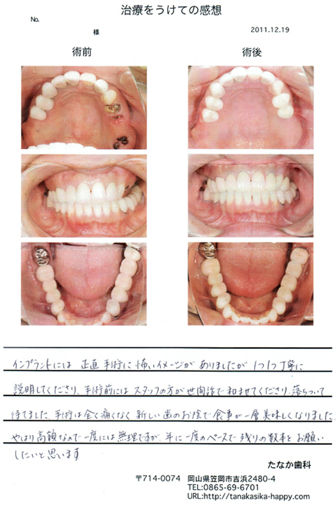 手術は全く痛くなく新しい歯のお陰で食事が一層美味しくなりました
